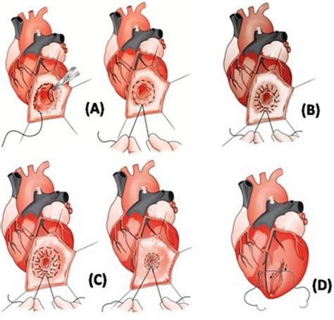 left ventricular aneurysm treatment